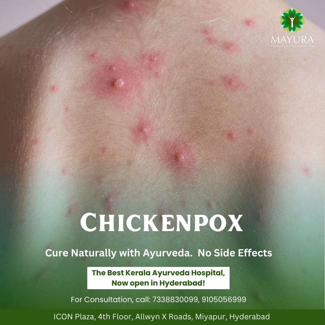 Chickenpox