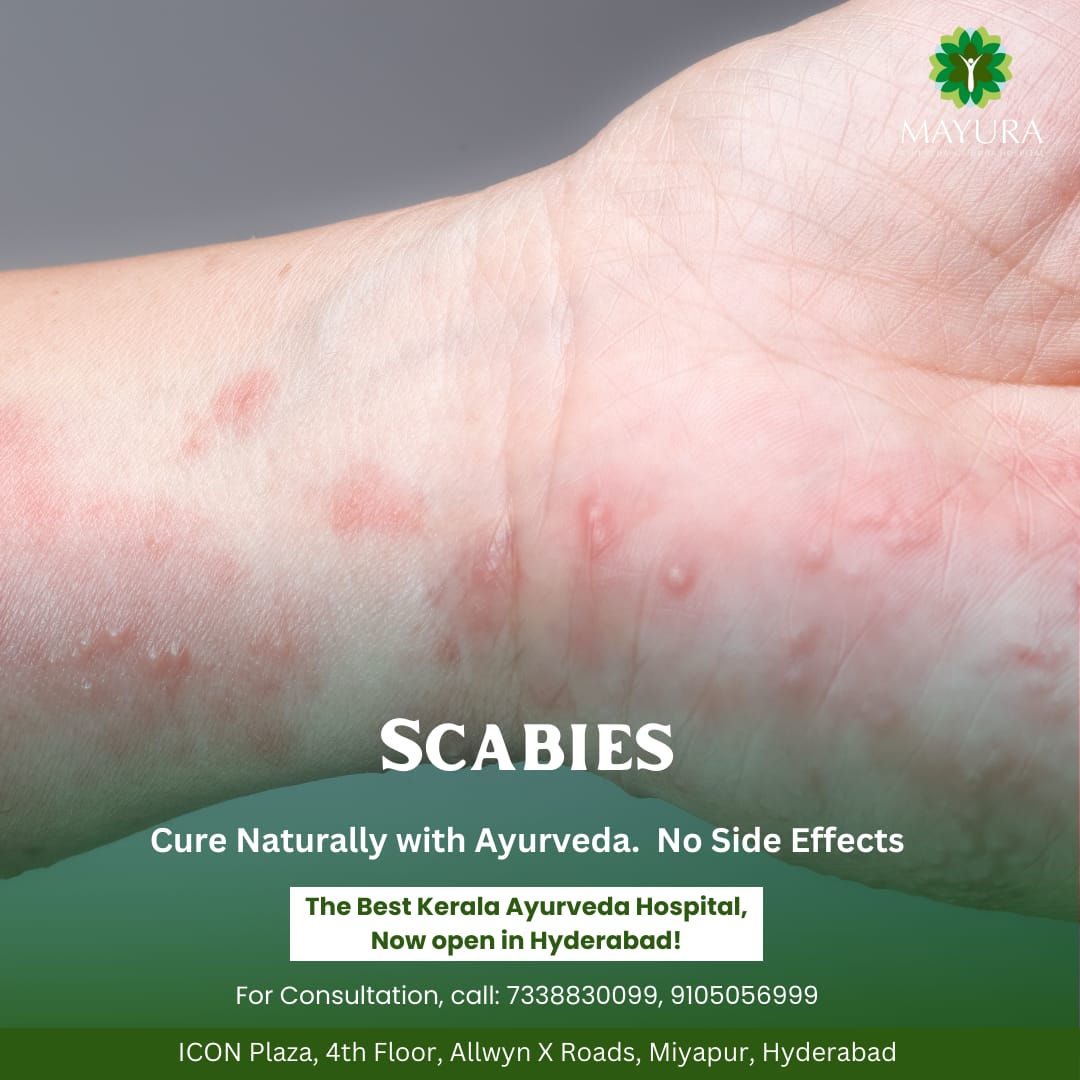 Scabies